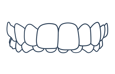 Overbite example for Invisalign